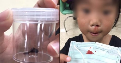 2岁女童嬉水误吸入水蛭 持续十多天狂流鼻血