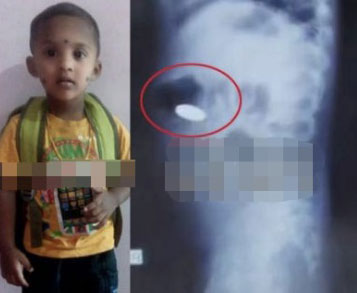 印度3岁男孩（左）意外吞下一枚硬币，X光显示硬币在胃里的位置。