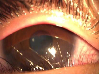 男童“下眼睑赘皮”情形严重，把睫毛往眼球方向推，造成眼角膜擦损及混浊。