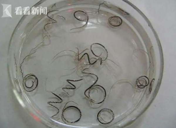 医生在男子的脑脊液里检查出一种叫“广州管圆寄生虫”的基因序列，序列数高达上万。