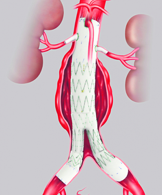 血管腔内主动脉瘤修复术(EVAR)是腹主动脉瘤(abdominal aortic aneurysm, AAA)治疗的一项微侵入性手术，也是腹主动脉瘤的重大进展。