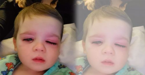 2岁宝宝玩具挤水喷到眼 患蜂窝性组织炎险失明