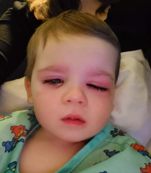 贝勒洗澡时，把洗澡玩具里的水喷到眼睛里，最后竟得到蜂窝性组织炎，红肿范围从双眼蔓延到整个脸颊。