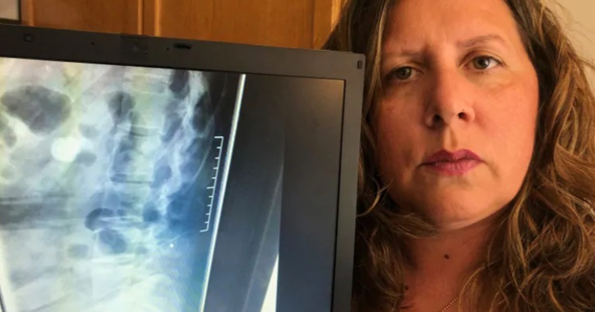 伊波利托展示的X光照片，显示她的脊椎内藏针头。