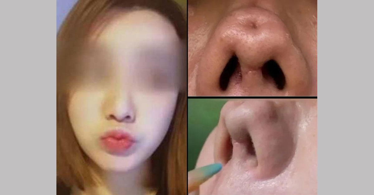 女主播花2万4000元人民币做“隆鼻修复术”，竟把鼻子弄凹了，不敢见人。