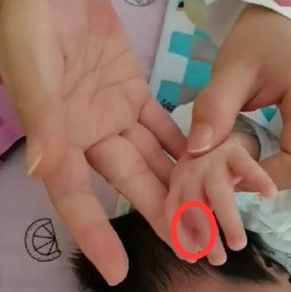 女婴的下巴、嘴角和左手的手指均有伤口。