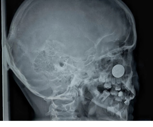 X光照片显示，男子的鼻腔的右侧被一个圆形的物体堵着。
