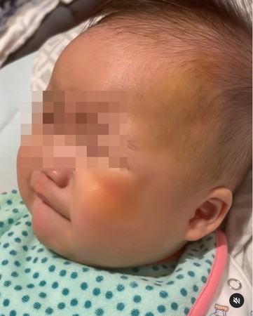 苏淼淼6个月大的宝宝被歹徒粗暴抓头受伤。