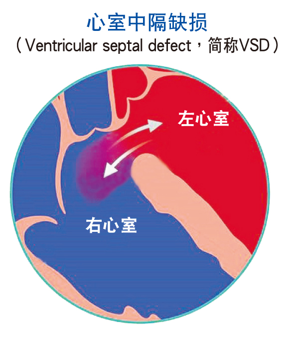 下部腔室这道墙有缺损、孔隙或破洞，导致左心室部分富含氧气的血液流向右心室。