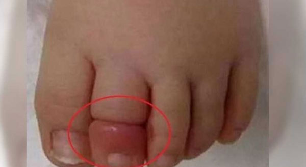 女婴脚趾肿胀情况。
