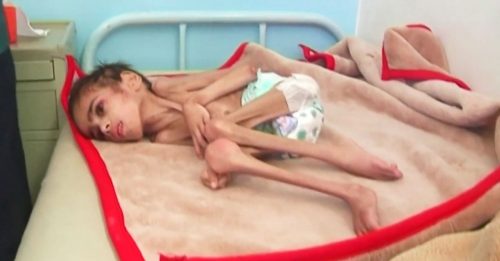 也门内战逾6年致大饥荒  7岁男童皮包骨仅剩7公斤