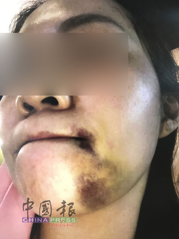 刘俐君的下巴严重受伤，大牙也被打脱。