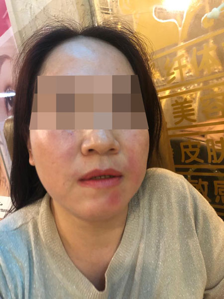 陳女士稱安琪和女職員對她拳打腳踢，導致她臉部紅腫。（受訪者提供）