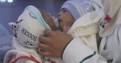 抢救也门连体婴 联国协助送至约旦动手术