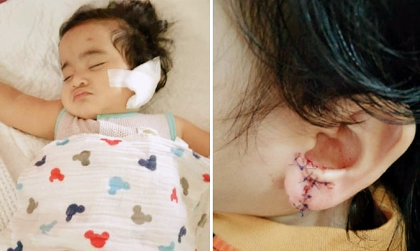 10个月大女婴因耳环被“卷”进电风扇叶片，导致左耳垂被“撕裂”，送院缝针。