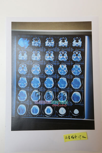 死者脑部CT扫描结果显示，死者脑内有积血。