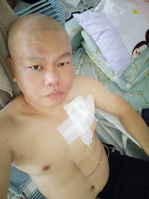 切肝后的化疗过程，令刘国华出现严重的脱发现象。