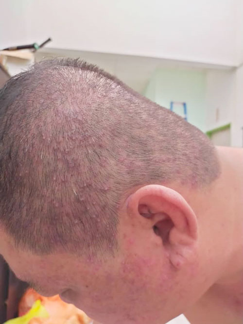 去年的化疗疗程令刘国华头皮和脸部出现溃烂情况。