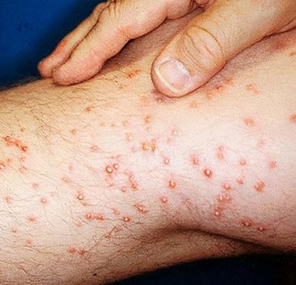 被红火蚁捅到人会发生过敏而出现皮疹。