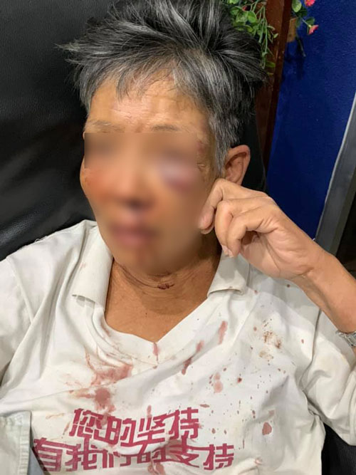 七旬老妇指控被装修商夫妇殴打受伤。