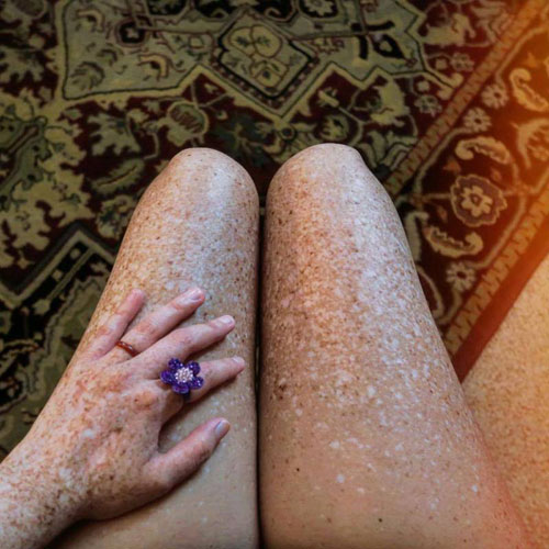 罕见皮肤病，着色性干皮症的患者，会对紫外线过敏，接触阳光后皮肤会出现黑斑和皱摺。