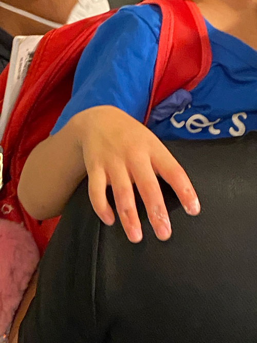 小男孩的三根手指被解救出来后，看起来像被“夹扁”了似的。（读者提供）