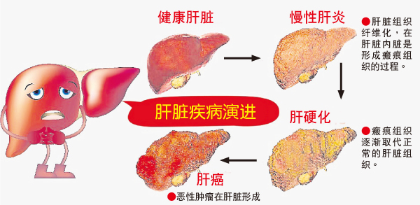 肝癌进行曲～肝癌并非一夕之间发生的，健康的肝脏会经过肝炎、肝硬化等阶段，最终在肝脏形成恶性肿瘤。