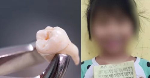 拔1颗牙赔上性命 5岁女童失血脑死