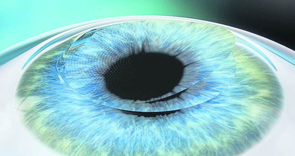 飞秒激光技术（FemtoLASIK） 飞秒激光技术（FemtoLASIK）是一项安全无痛、快速恢复及无不适感的“无刀”手术。这项技术从90年代研发至今已经成为眼科领域广泛采用的激光视力矫正技术。医生首先需要使用飞秒激光在分子水平上分离角膜组织，接着再根据患者个别情况使用准激光重塑角膜来矫正视力。