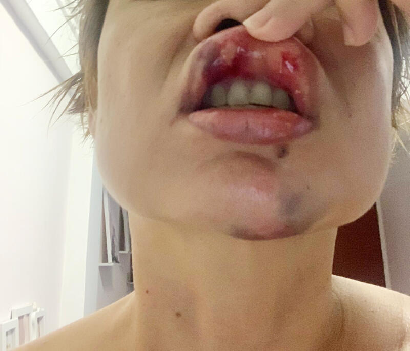 时隔数日后，何女士的下颚及嘴唇的伤势依然清晰可见。（目击者提供）
