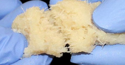 美国多州罕见结核病 已113人感染