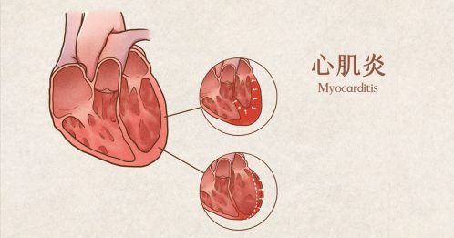 ◤全球大流行◢ 年轻人打疫苗后 数百人爆心肌炎