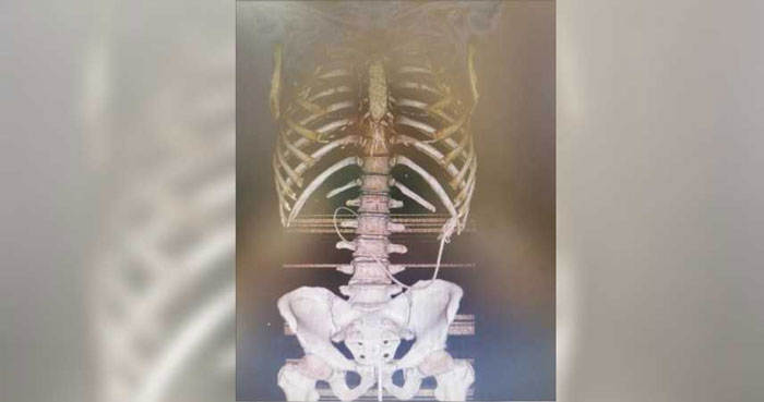 X光图片显示黄鳝在男子的肠中。