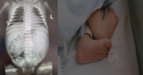 女婴“怀双包胎” 具备心脏骨头
