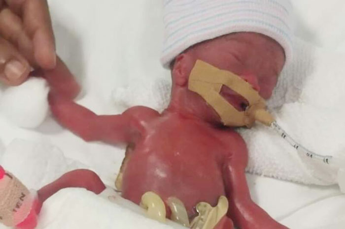 相信是世界最轻并幸存的早产婴儿郭玉媗，出生时体重仅212克。（受访者提供）