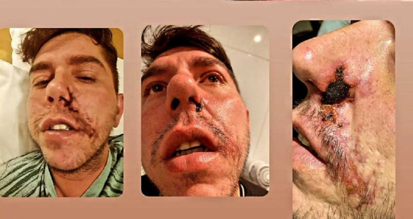 蒂亚戈手术失败，导致脸上出现第3个鼻孔。