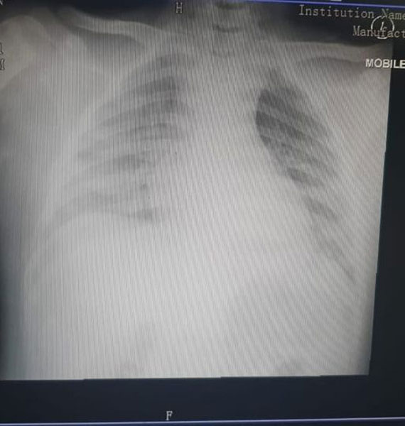 Celine在面子书张贴确诊小孩的肺部X光片，说明新冠肺炎对该群体造成的伤害。