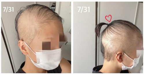 ◤全球大流行◢女子打疫苗副作用 大量掉头发见头皮
