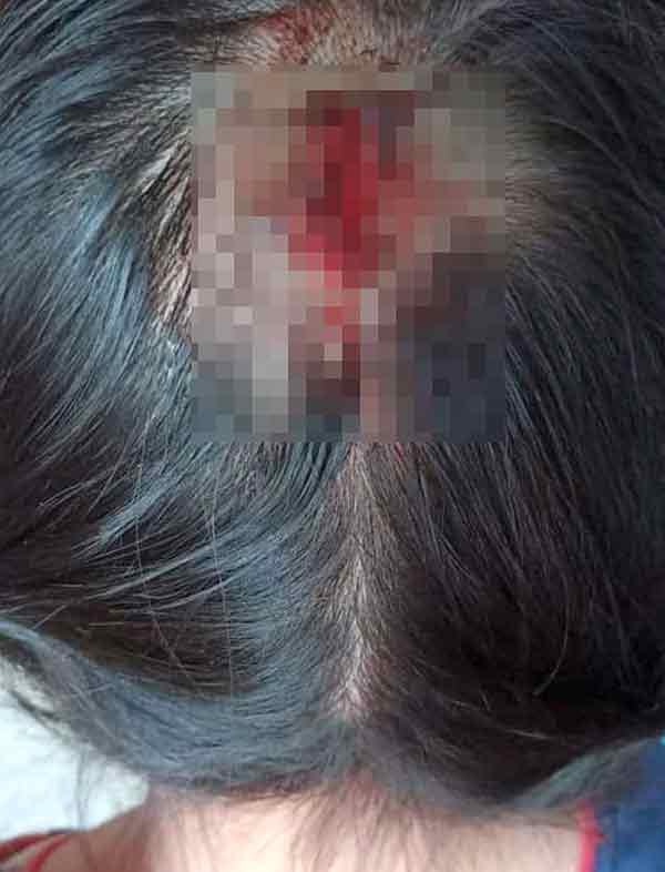 女童被虐打至头破血流。