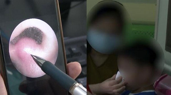 8岁男童挖鼻孔出血致颅内感染。
