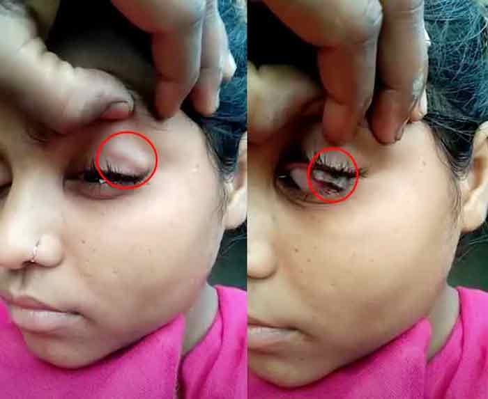 印度1名15岁少女，只要哭泣眼睛便会掉出石头。