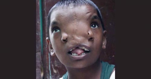 女童动手术后长出2个鼻子 村民当神膜拜