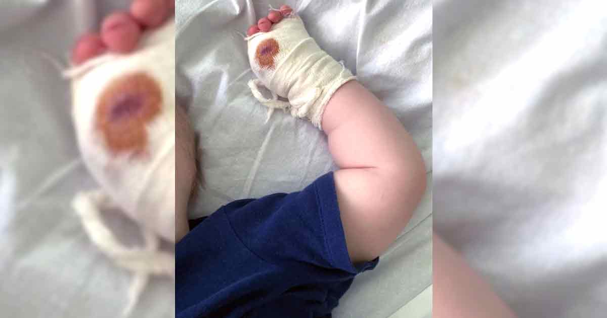 安娜塔西亚的儿子，拇指被老虎咬断，送往医院包扎。