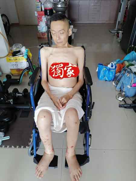 李文俊在治病过程中，体重暴瘦约40公斤。（家人提供）