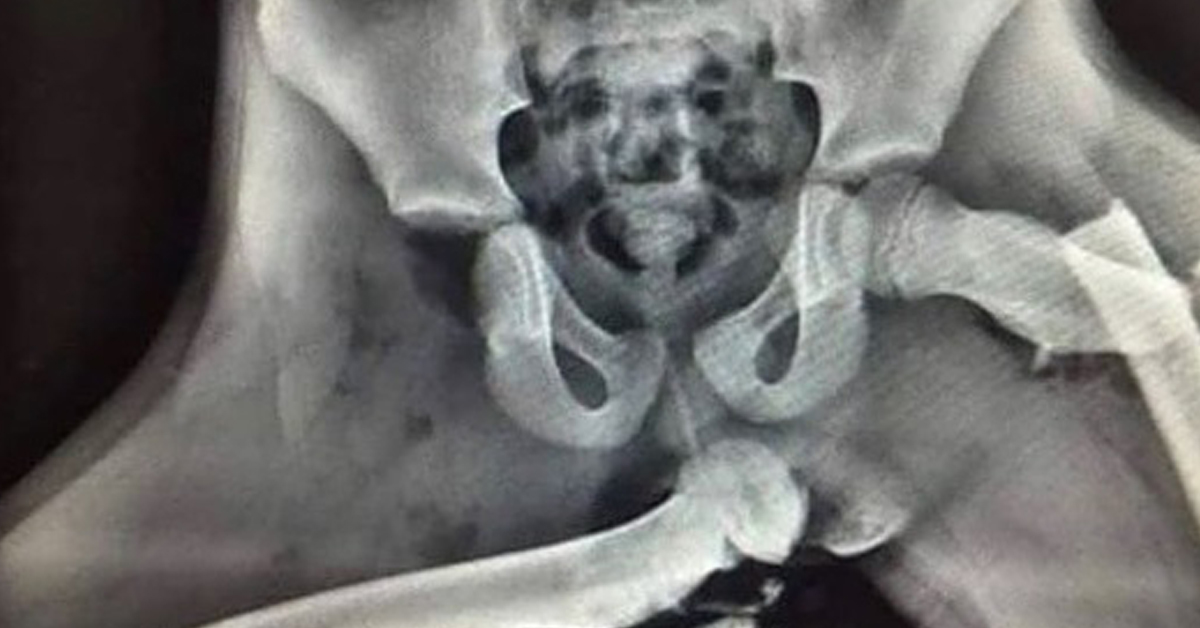 X光照显示，女子的腿骨（股骨）完全从髋关节的髋臼上脱落，位移到了坐骨下方，戳出皮肤再插进屁股。