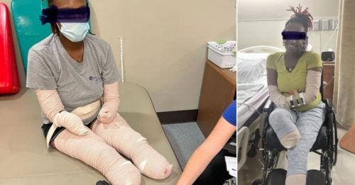 ◤全球大流行◢ 32岁三宝妈染疫 被迫 四肢截肢