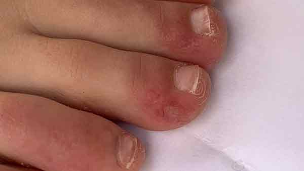 全球有多起“新冠脚趾”病例，“新冠脚趾”呈红或紫色。
