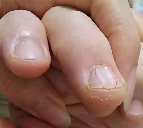 一名女网友发现自己指甲上有凹槽，有过来人看了分享自己的经验，劝她赶紧去就医检查。