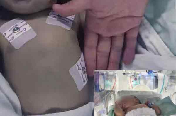 亚硝酸盐中毒的婴儿送往医院时全身发紫。