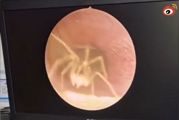 一只活蜘蛛在女子的耳朵鼓膜表面爬行。